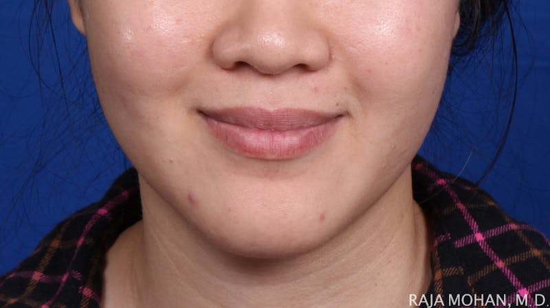 Buccal Fat Pad Removal Before & After Gallery - Patient 122420 - Image 2
