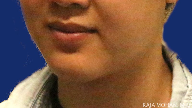 Buccal Fat Pad Removal Before & After Gallery - Patient 122420 - Image 3
