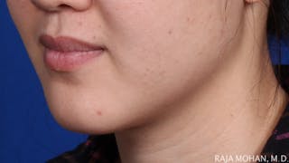 Buccal Fat Pad Removal Before & After Gallery - Patient 122420 - Image 4