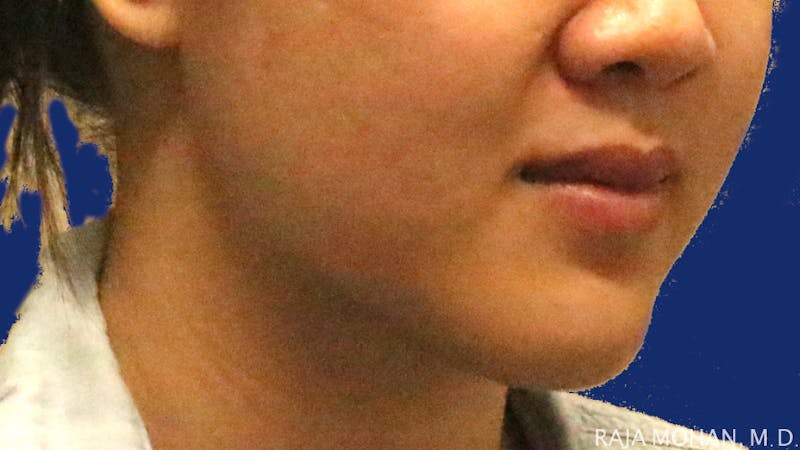Buccal Fat Pad Removal Before & After Gallery - Patient 122420 - Image 5