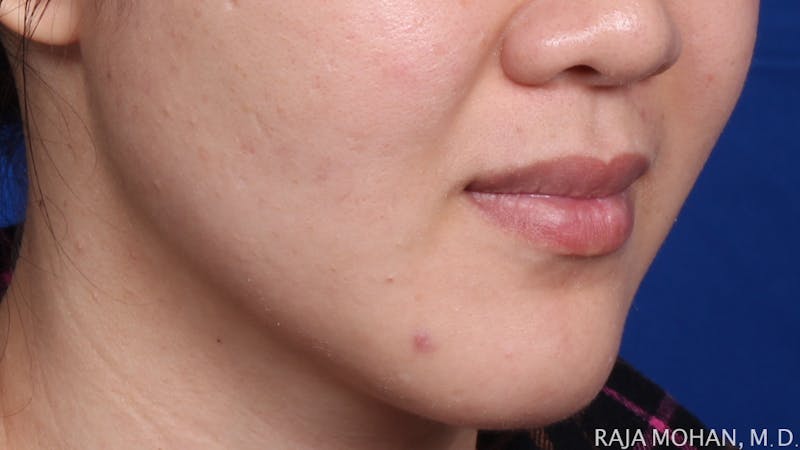 Buccal Fat Pad Removal Before & After Gallery - Patient 122420 - Image 6