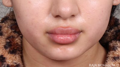 Buccal Fat Pad Removal Before & After Gallery - Patient 240230 - Image 1