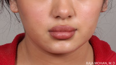 Buccal Fat Pad Removal Before & After Gallery - Patient 240230 - Image 2