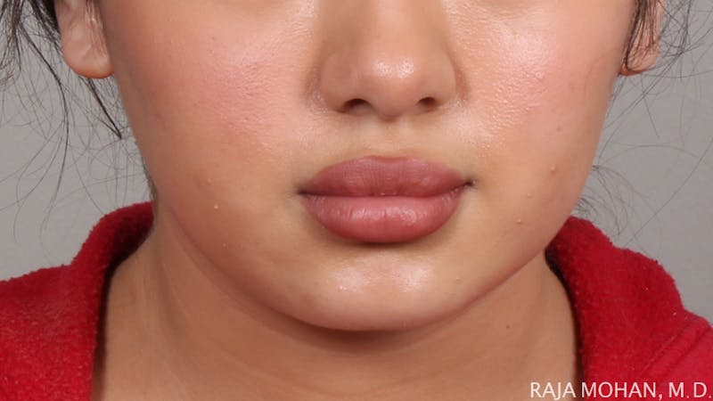 Buccal Fat Pad Removal Before & After Gallery - Patient 240230 - Image 2