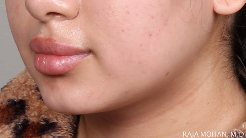 Buccal Fat Pad Removal Before & After Gallery - Patient 240230 - Image 3