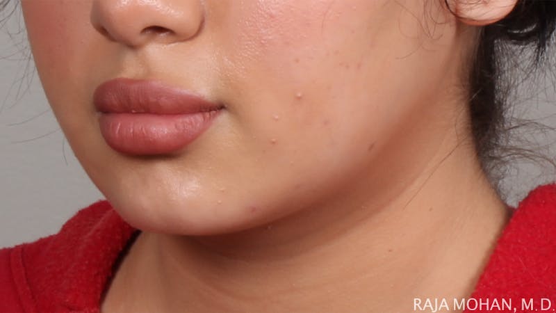 Buccal Fat Pad Removal Before & After Gallery - Patient 240230 - Image 4