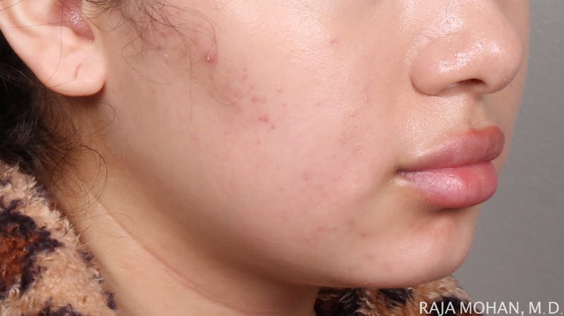 Buccal Fat Pad Removal Before & After Gallery - Patient 240230 - Image 5