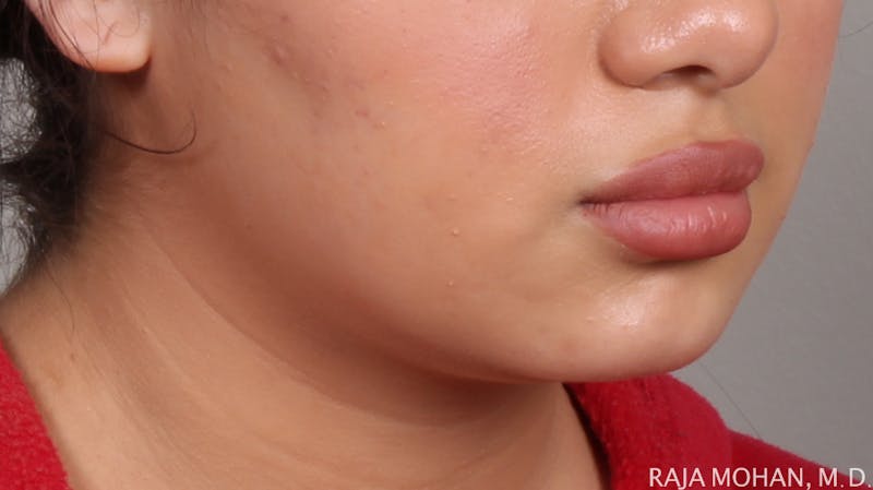 Buccal Fat Pad Removal Before & After Gallery - Patient 240230 - Image 6