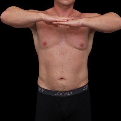 Hi Def Lipo Before & After Gallery - Patient 345476 - Image 1