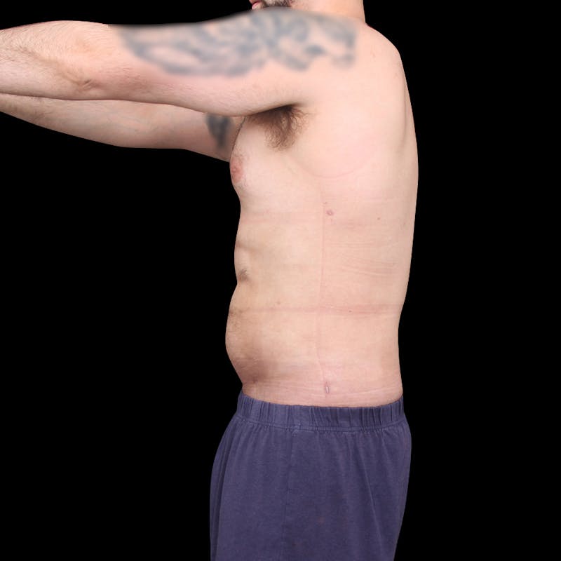 Ab Etching Before & After Gallery - Patient 418627 - Image 6