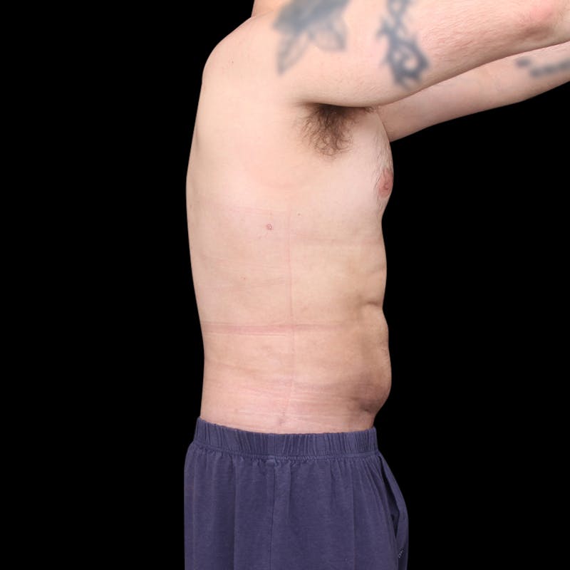 Ab Etching Before & After Gallery - Patient 418627 - Image 10