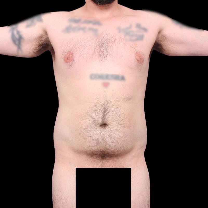 Ab Etching Before & After Gallery - Patient 418627 - Image 3