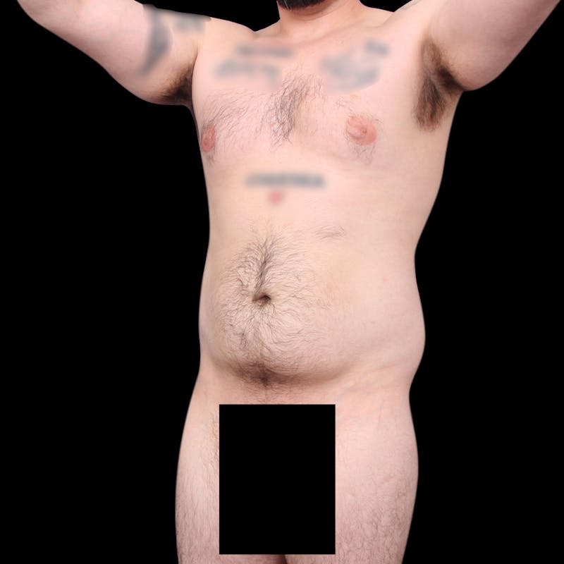 Ab Etching Before & After Gallery - Patient 418627 - Image 1