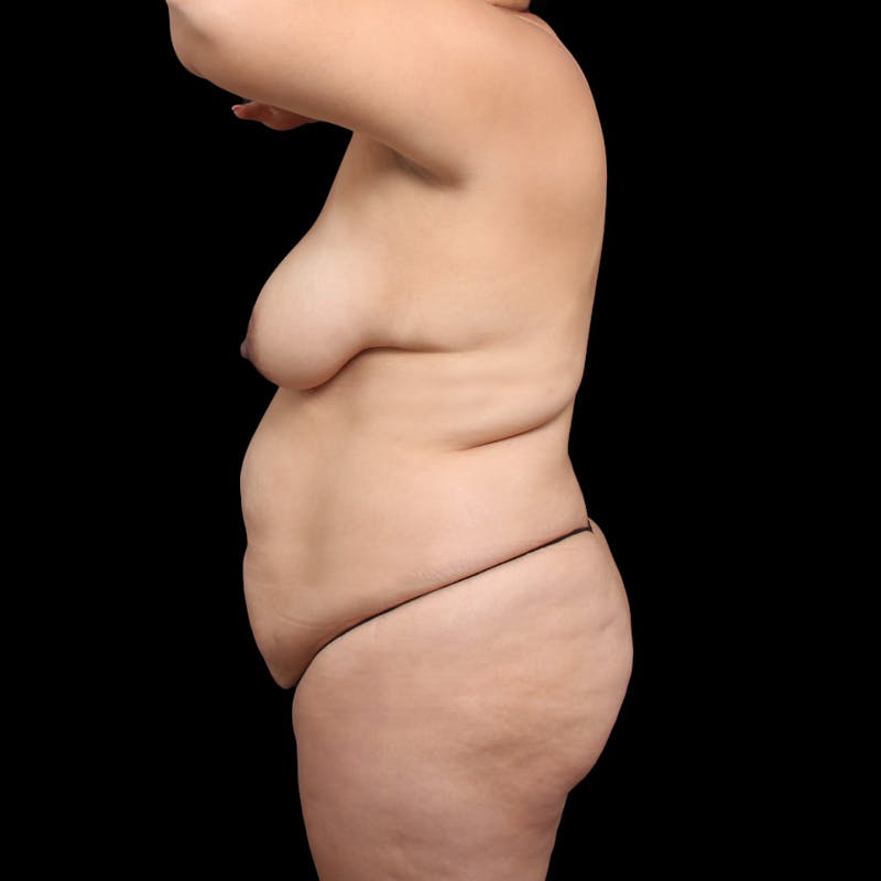 Brazilian Butt Lift Before & After Gallery - Patient 620231 - Image 7