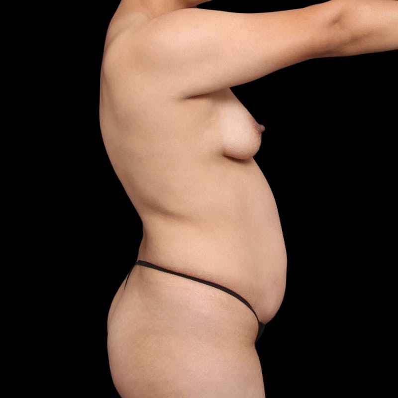 Tummy Tuck Before & After Gallery - Patient 305198 - Image 11