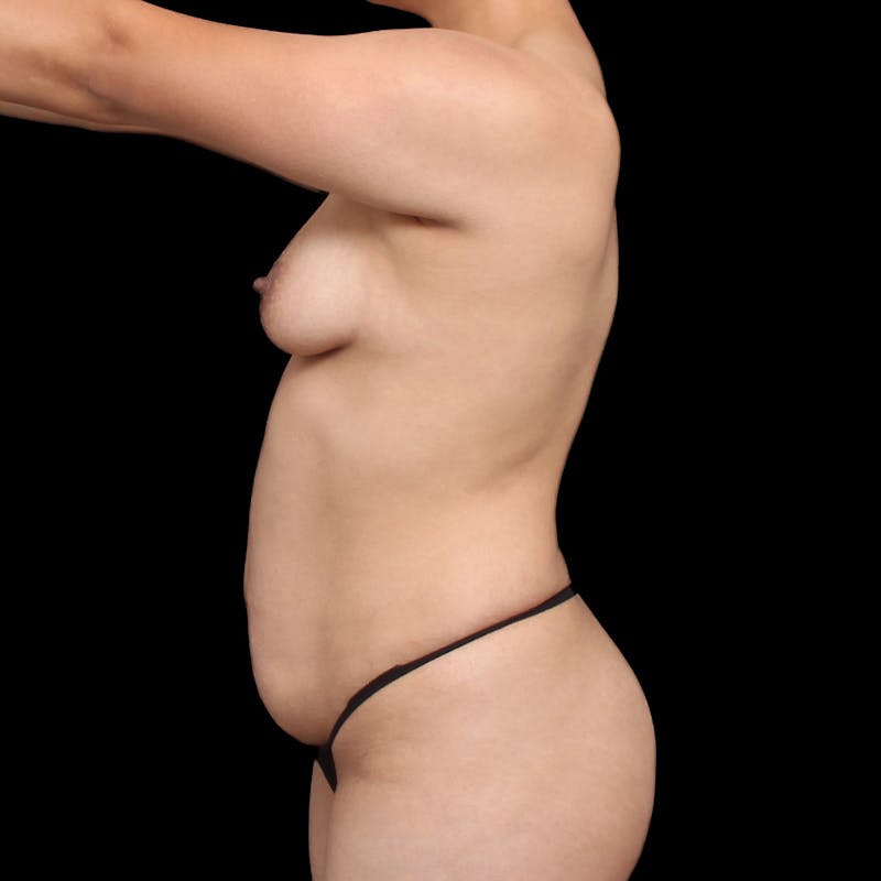 Tummy Tuck Before & After Gallery - Patient 305198 - Image 9