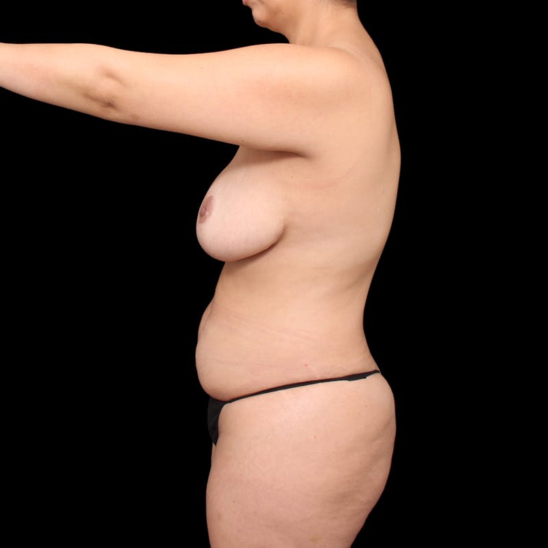 Tummy Tuck Before & After Gallery - Patient 253443 - Image 11