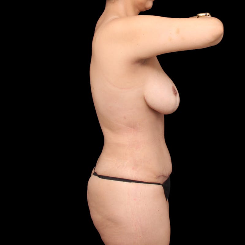 Tummy Tuck Before & After Gallery - Patient 253443 - Image 10