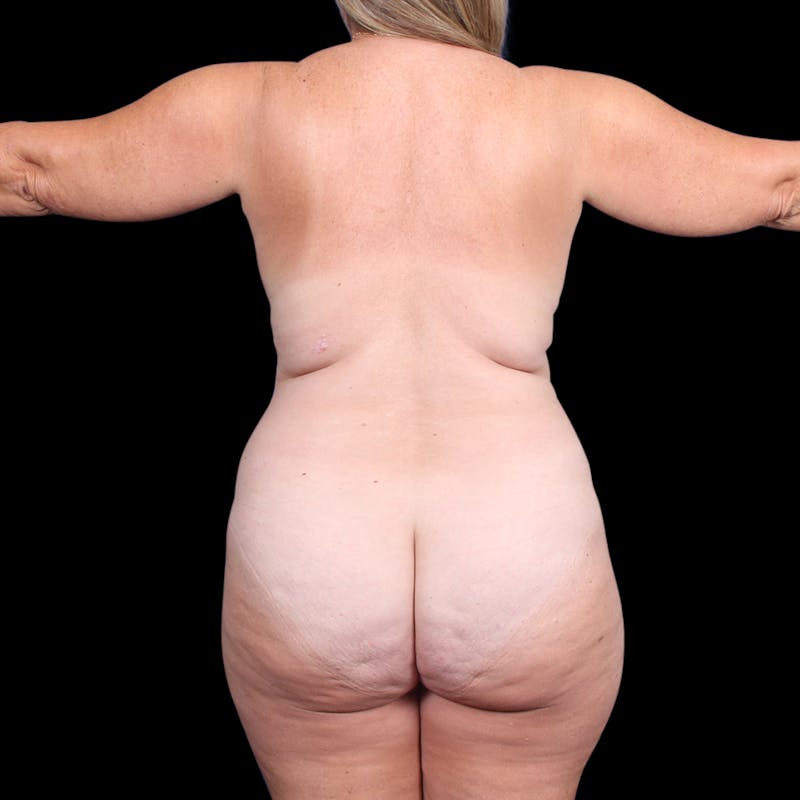 Tummy Tuck Before & After Gallery - Patient 288968 - Image 5