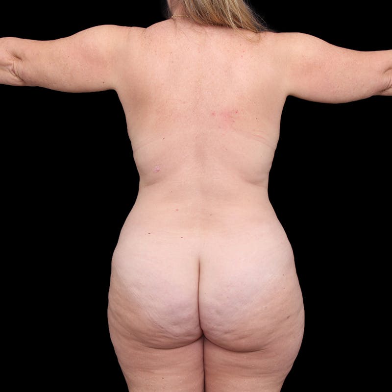 Tummy Tuck Before & After Gallery - Patient 288968 - Image 6
