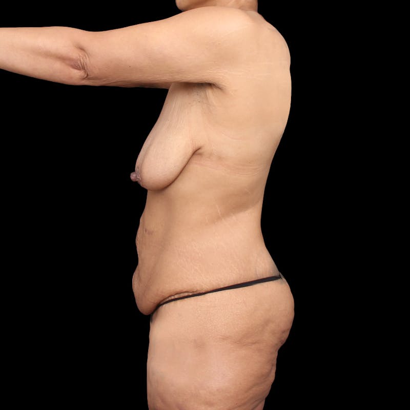 Tummy Tuck Before & After Gallery - Patient 305266 - Image 9