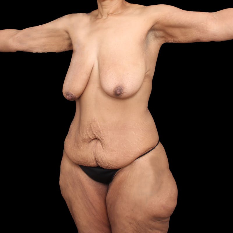 Tummy Tuck Before & After Gallery - Patient 305266 - Image 3