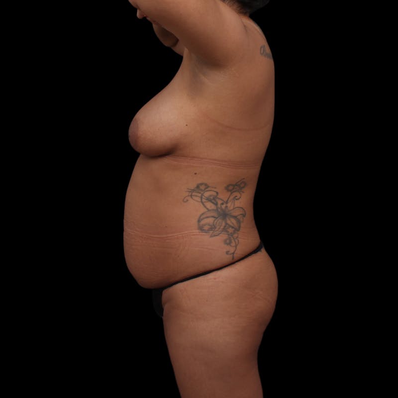 Tummy Tuck Before & After Gallery - Patient 145414 - Image 9
