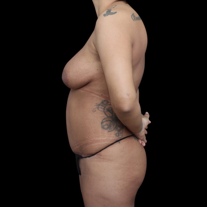 Tummy Tuck Before & After Gallery - Patient 145414 - Image 10