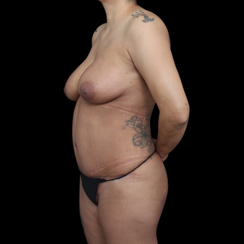 Tummy Tuck Before & After Gallery - Patient 145414 - Image 4