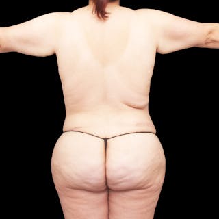 Tummy Tuck Before & After Gallery - Patient 317082 - Image 12