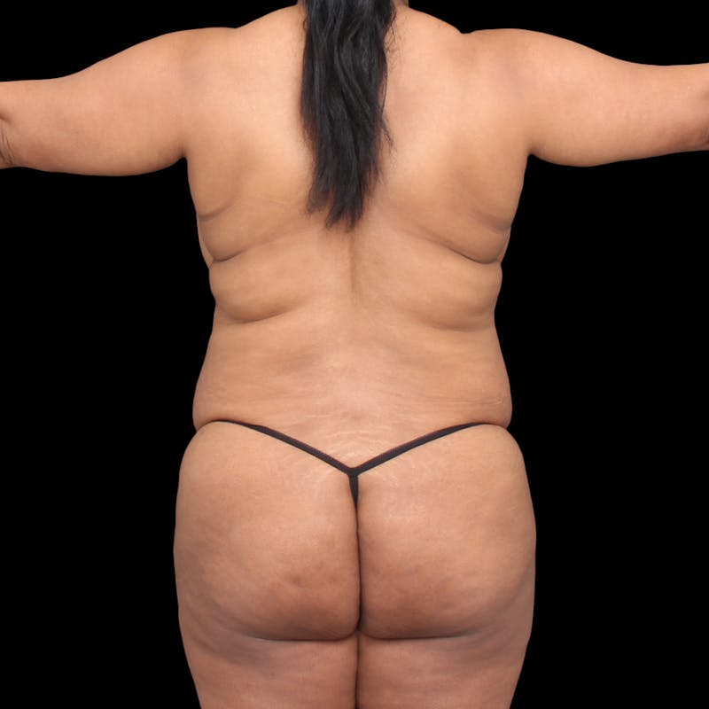 Tummy Tuck Before & After Gallery - Patient 301645 - Image 11