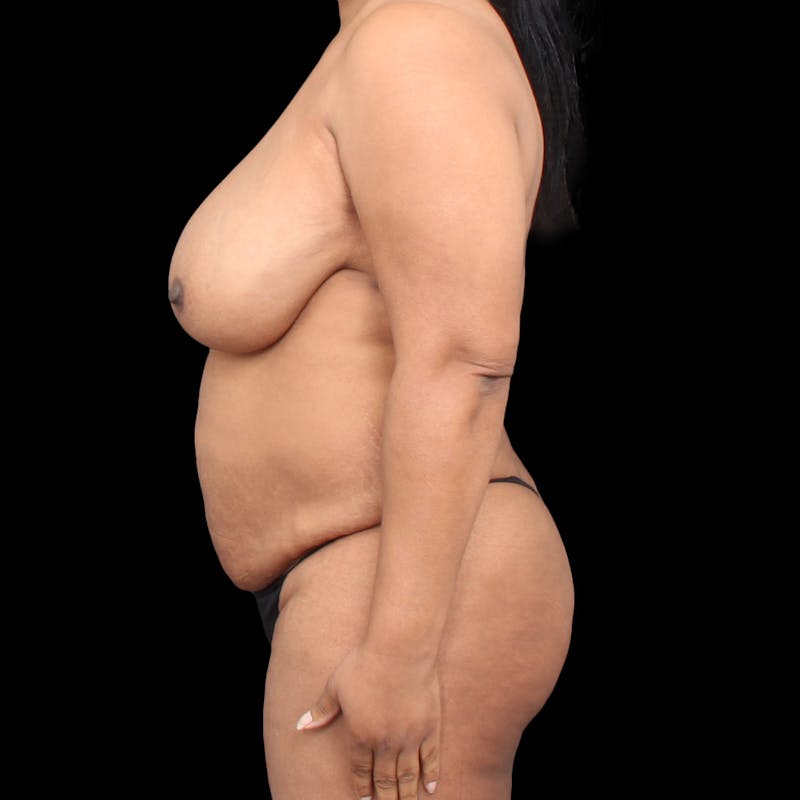 Tummy Tuck Before & After Gallery - Patient 301645 - Image 5