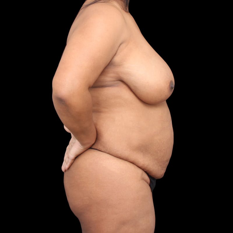 Tummy Tuck Before & After Gallery - Patient 301645 - Image 9