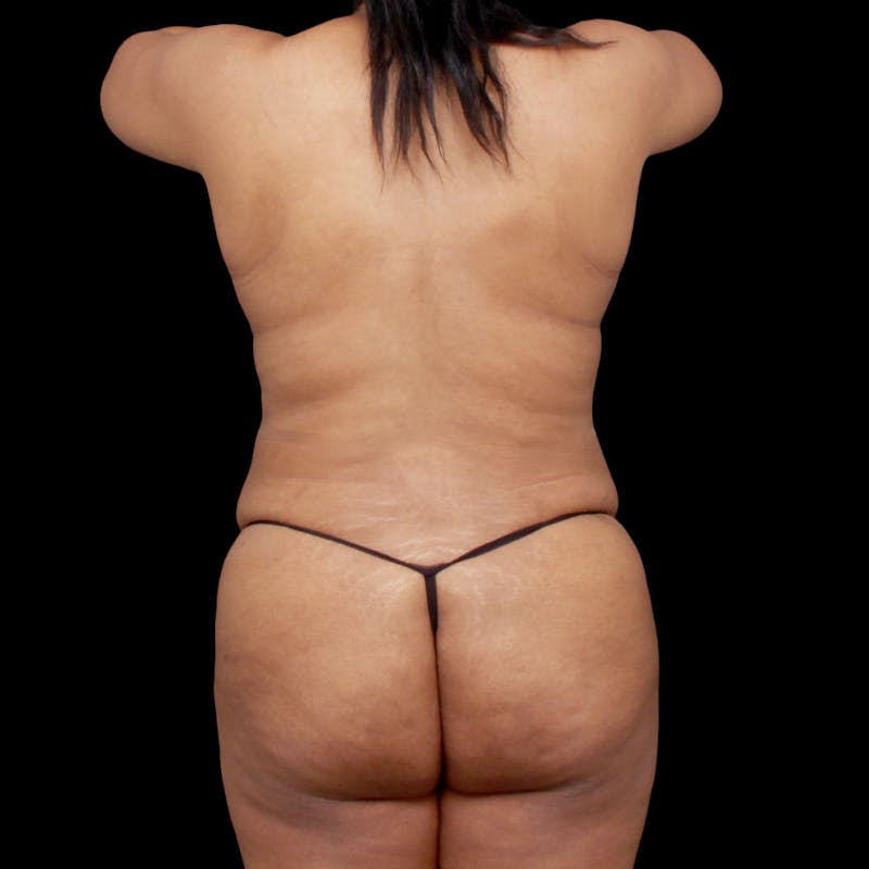 Tummy Tuck Before & After Gallery - Patient 301645 - Image 12