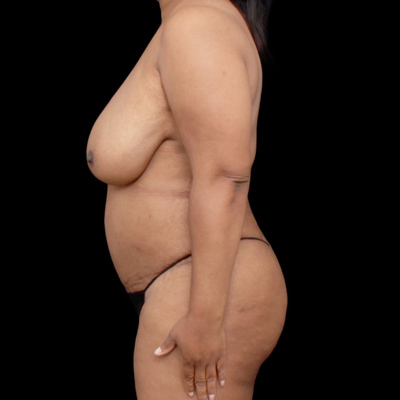 Tummy Tuck Before & After Gallery - Patient 301645 - Image 6