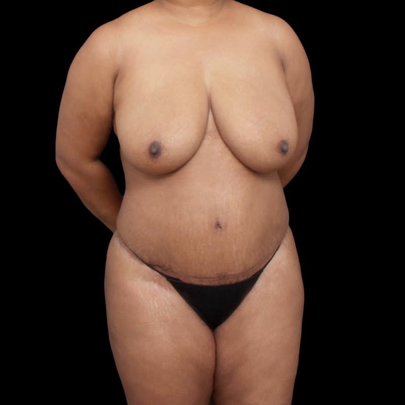 Tummy Tuck Before & After Gallery - Patient 301645 - Image 8