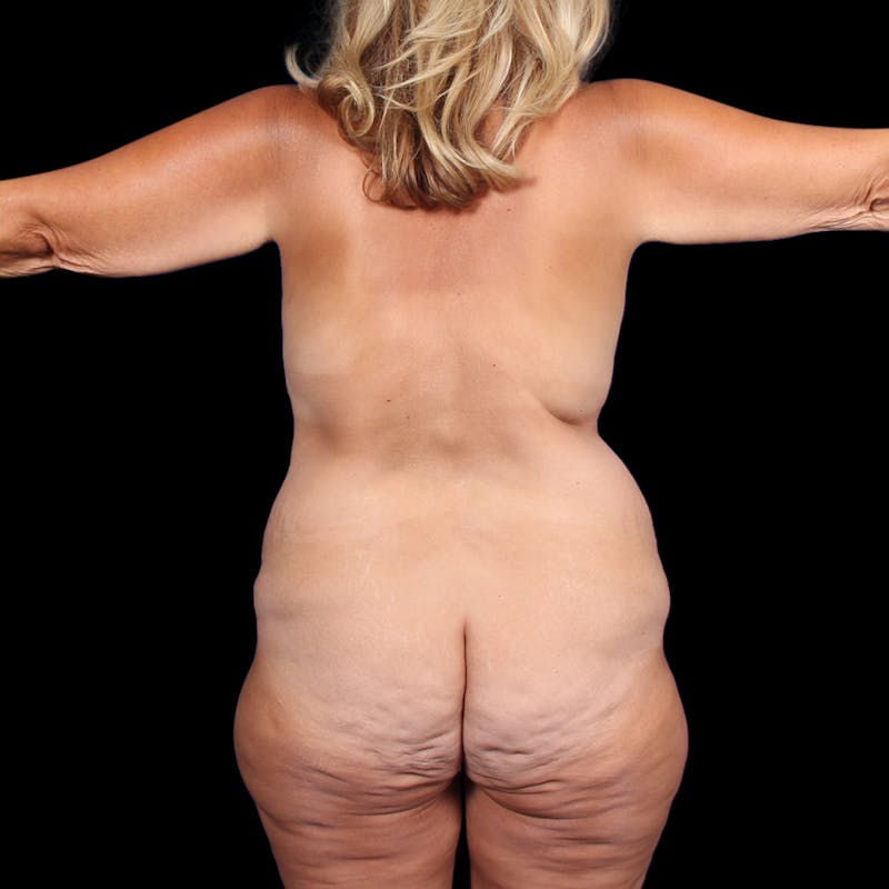 Tummy Tuck Before & After Gallery - Patient 188280 - Image 11