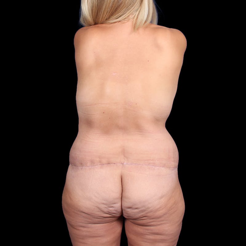 Tummy Tuck Before & After Gallery - Patient 188280 - Image 12