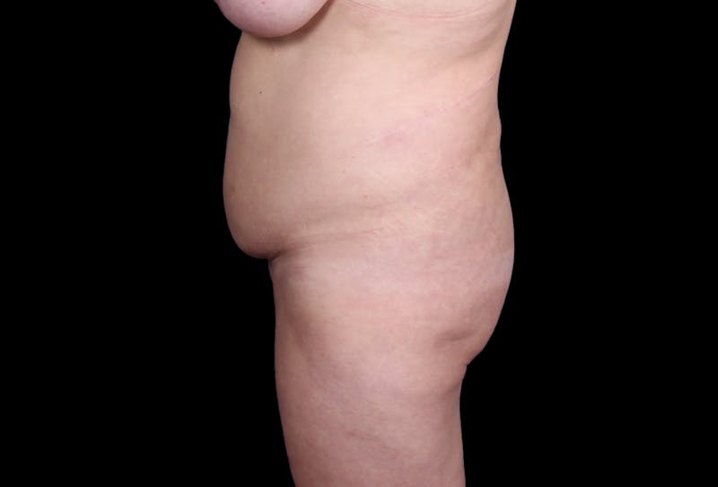 Tummy Tuck Before & After Gallery - Patient 207191 - Image 9