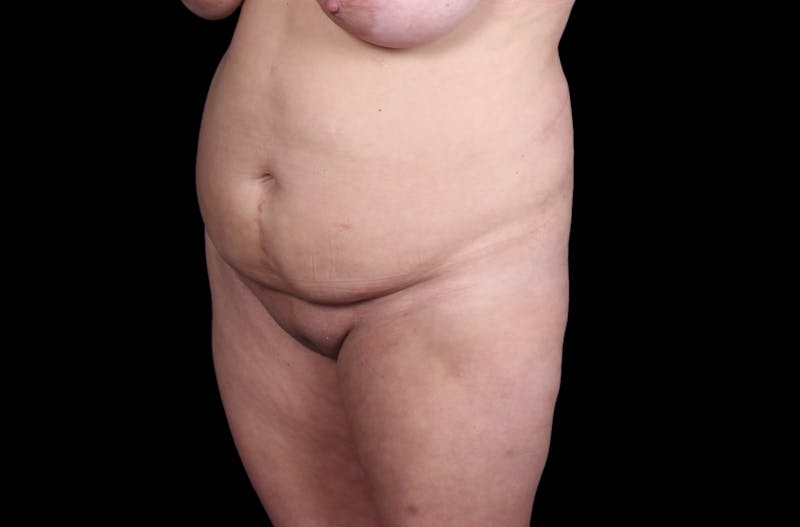 Tummy Tuck Before & After Gallery - Patient 207191 - Image 3