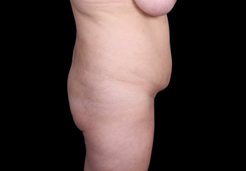 Tummy Tuck Before & After Gallery - Patient 207191 - Image 5
