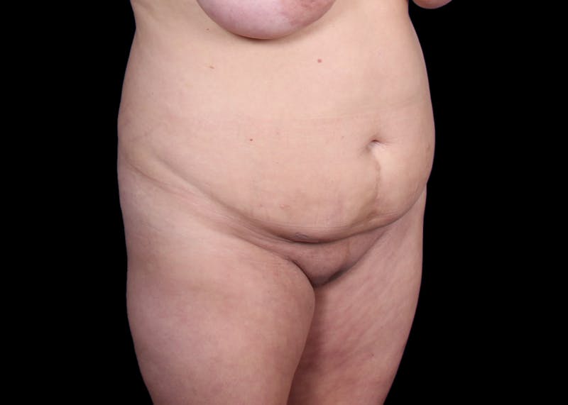 Tummy Tuck Before & After Gallery - Patient 207191 - Image 7