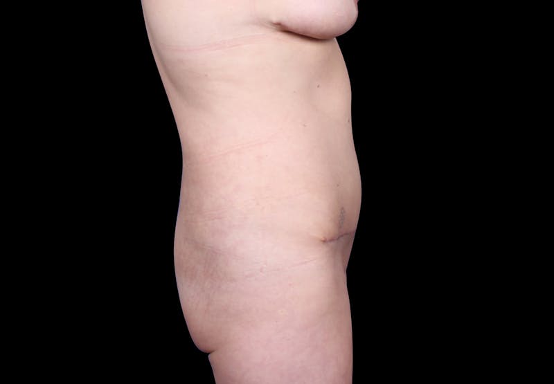 Tummy Tuck Before & After Gallery - Patient 207191 - Image 6