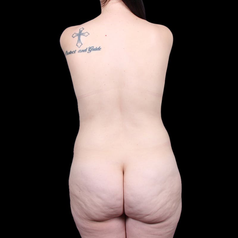Tummy Tuck Before & After Gallery - Patient 139827 - Image 11