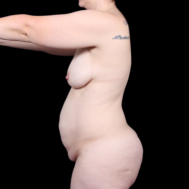 Tummy Tuck Before & After Gallery - Patient 139827 - Image 5