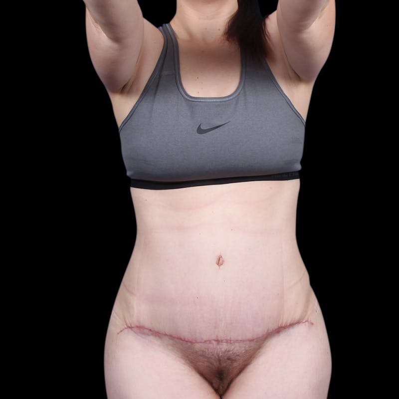Tummy Tuck Before & After Gallery - Patient 139827 - Image 2