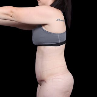 Tummy Tuck Before & After Gallery - Patient 139827 - Image 6