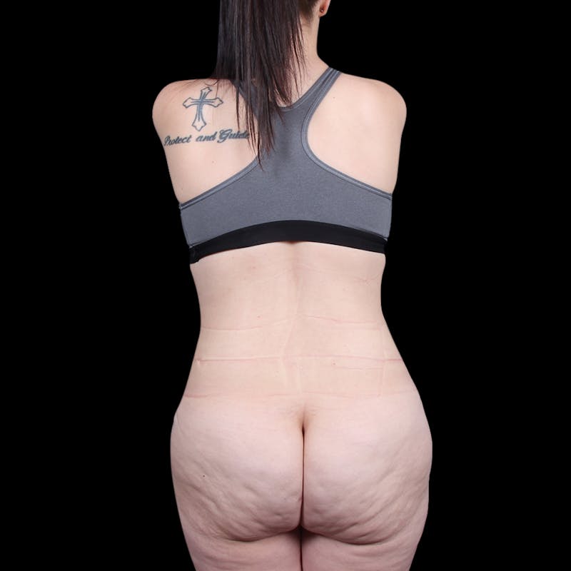 Tummy Tuck Before & After Gallery - Patient 139827 - Image 12