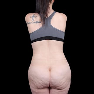 Tummy Tuck Before & After Gallery - Patient 139827 - Image 12