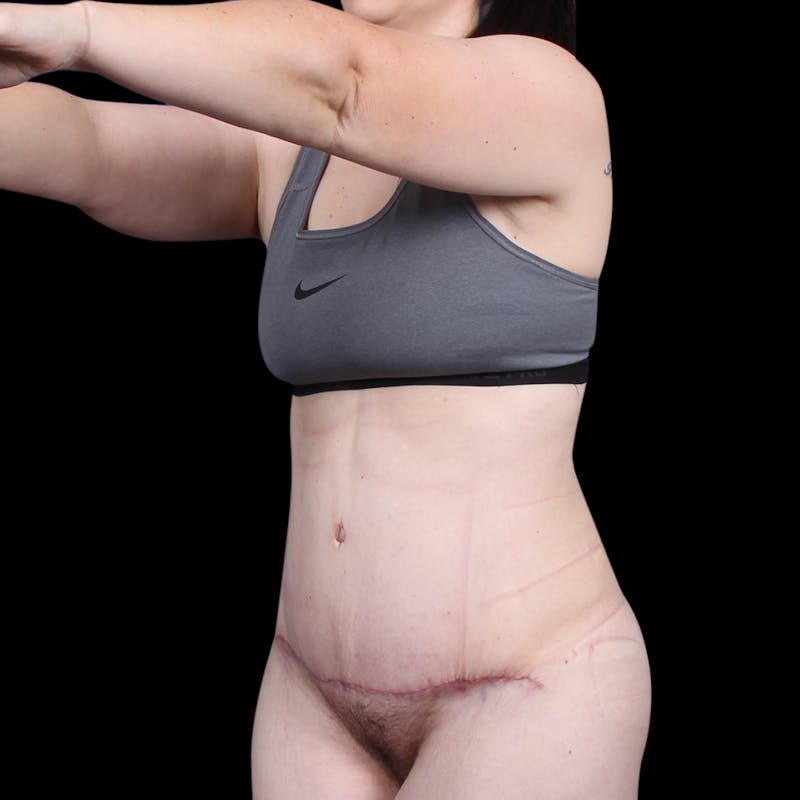 Tummy Tuck Before & After Gallery - Patient 139827 - Image 4